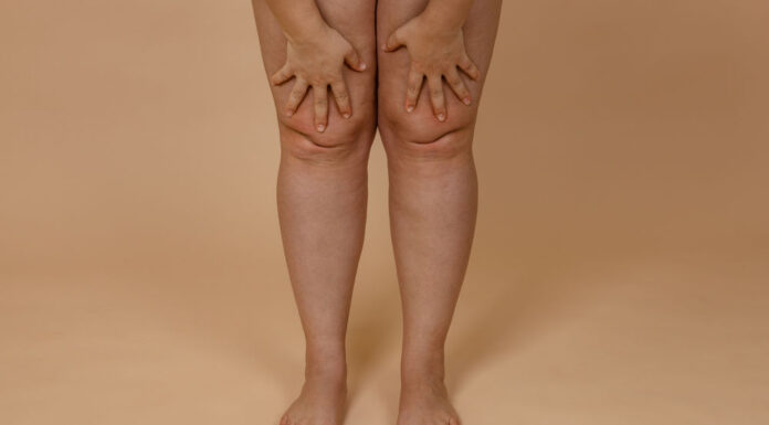 O que é e quais são as causas do lipedema?