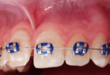 Freio da Língua e Freio Labial