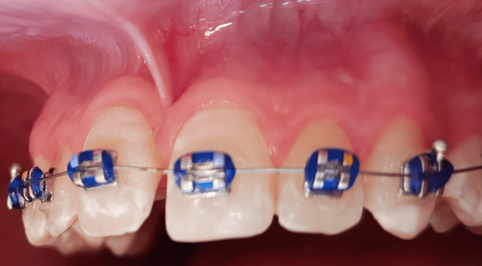 Freio da Língua e Freio Labial