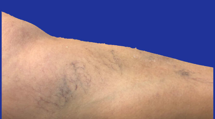 As varizes voltam após o tratamento? Verdade ou Mentira?