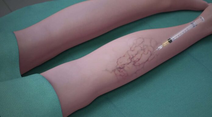 Escleroterapia, aplicação e secagem dos vasos: Como realmente funciona