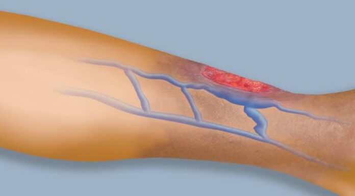 Úlcera Venosa: o que é, causas e tratamento?